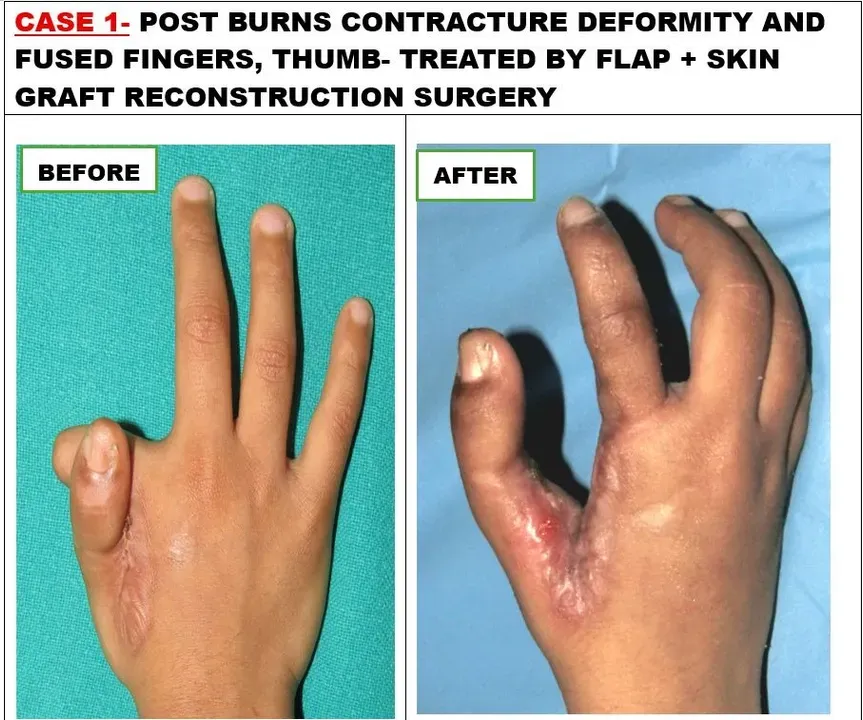 Advanced plastic surgery at AIIMS Jammu brings hope in complex hand injury